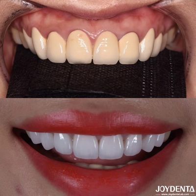 CAD/CAM 互換性 Zirconia 歯冠 調整された色とサイズのための精密製造
