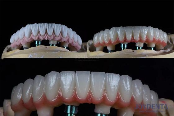 購入 10mm マルチパルス 歯 2 段階 歯科 インプラント キット 内骨 義肢 冠 オンライン製造