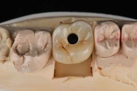 購入 タイタン 10mm シングル歯 歯科インプラント 入れ替え 歯盤 自動タッピング 砂吹き オンライン製造