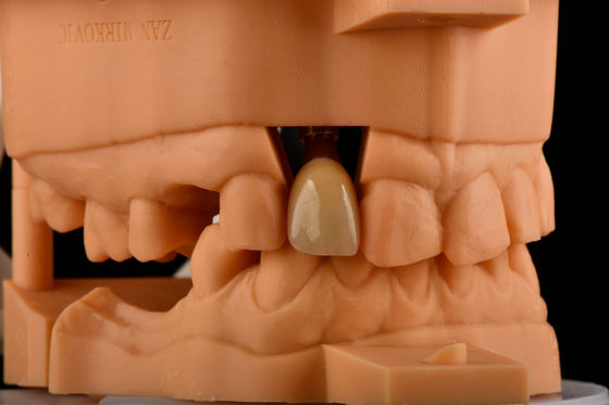 購入 内部ヘックス3.0mm 深さ1.5mmピッチ シングルチタン歯科インプラント 交換 オンライン製造