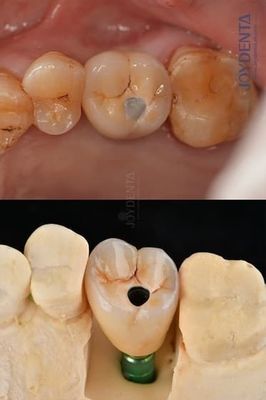 購入 タイタン フルアーチ 歯科インプラント 義肢プラットフォーム 4.1mm 優れた耐久性 オンライン製造