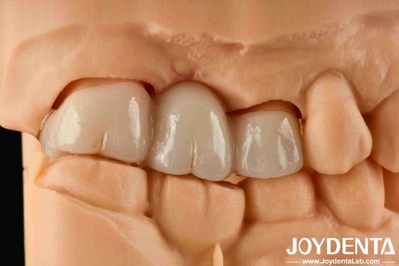 購入 経験色 現実的なフルジルコニア 染色に強い耐性 1000MPaの屈曲強度 オンライン製造