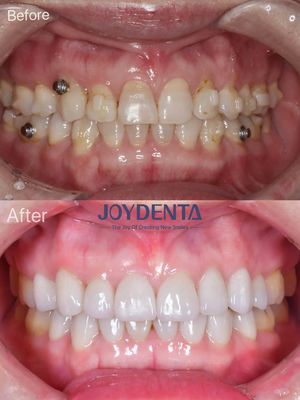 購入 ポルセラン プラネール 口腔 修復 オンライン製造