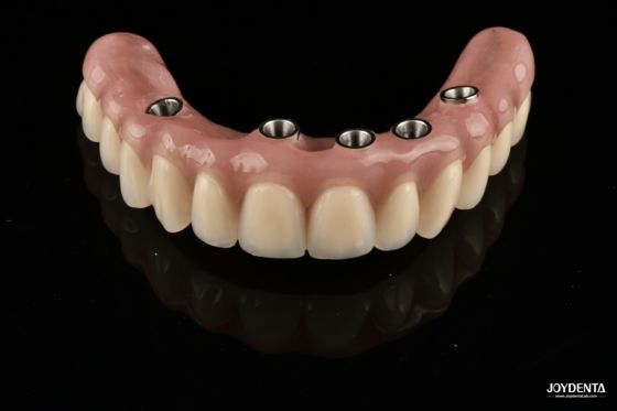 購入 Redefining Full Arch Prosthetics: Unmatched Fit and Function with Our Ti-Base Complete Dentures オンライン製造