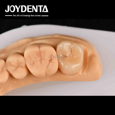 購入 高強度 エマックス インレイ オンレイ A2 カラー 損傷した歯の修復に長持ちする オンライン製造