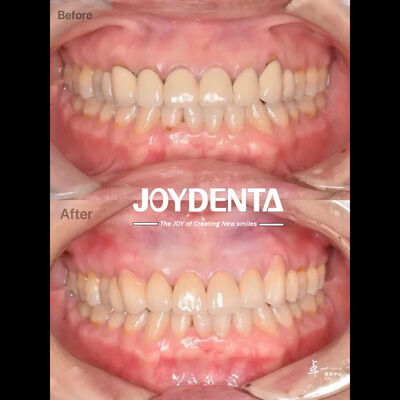 購入 安全な口腔組織のための歯科用ジルコニアとCAD/CAM互換性 オンライン製造