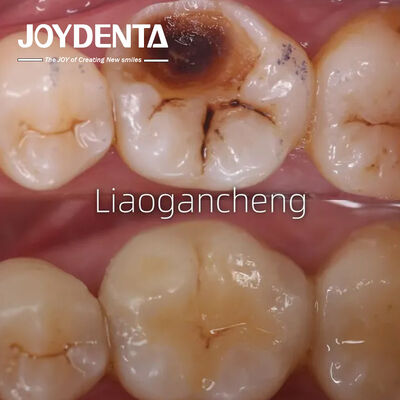 購入 大人と子供のためのポルセラン 歯科インレイ 復元 卓越した性能 オンライン製造