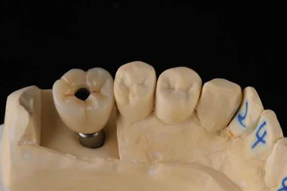 3.75mm シルバーチタンスクリュー 歯科インプラント 単歯の入れ歯