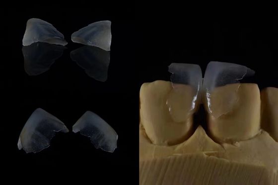快適な歯科フェニール 歯のエナメルと強い結合 安全なフィット 軽量でスムーズで最適な患者快適性