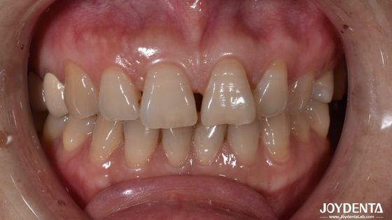 0.5mm 厚さ セラミック 歯のフロネーダー 前歯の表示を自然に見る