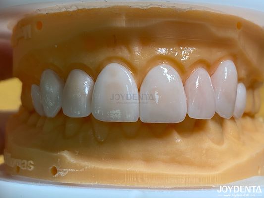 高透気性 天然外見のフェニール ポルセランフェニール エマックス オーダーメイド