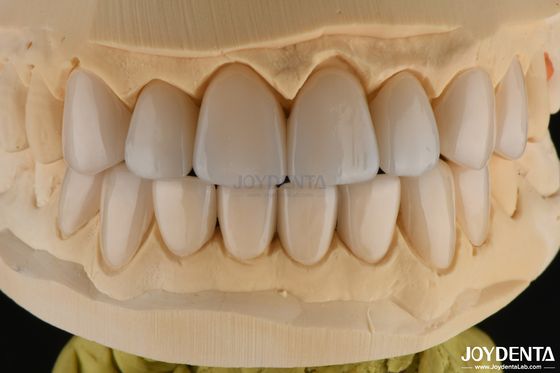 0.3-0.5mm 厚いフェルドスパシックポルセラン フェニエール 高い骨折耐性 笑顔を向上させる