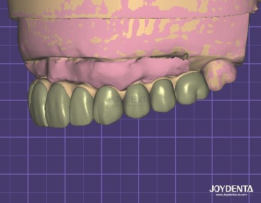 HIPAA に準拠するデータセキュリティ デジタルワックスアップ 3D 歯科改造モデル