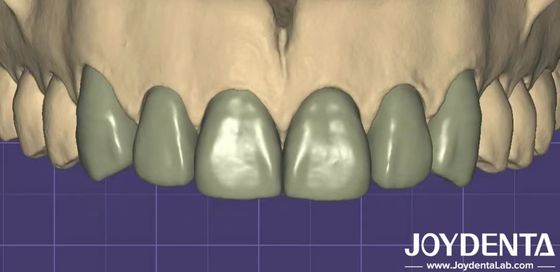 3Dプリント 仮想デジタルワックスアップ 他の歯科ソフトウェアとのシームレスな互換性