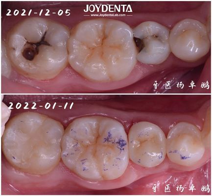 高耐久性 損傷した歯のためのインレイ歯科修復 サイズが異なります