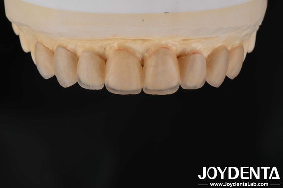 自然な外観 ガラスセラミックフェニッシュ 歯科クリニックフェニッシュ 強い絆