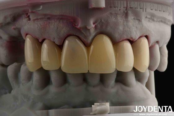 CAD CAM 処理 歯科 PMMA 素材 多層設計 自然な影の移行
