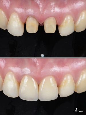 骨折耐性のある歯科ジルコニアと多層グラデント技術で作られたファニヤ