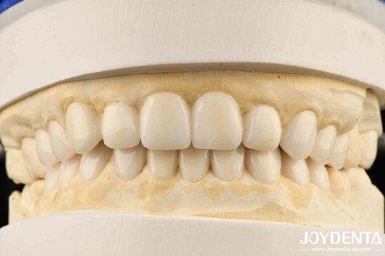 審美歯科バイオミメティック診断 ワックスアップ（ベニア）