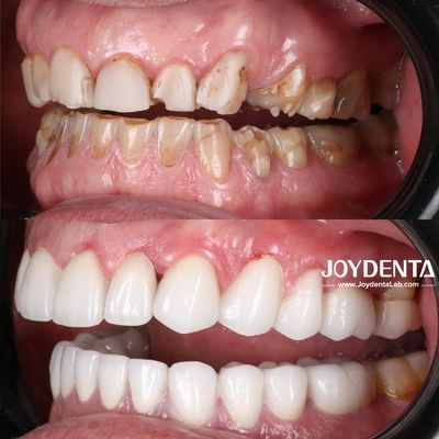 プレミアムジルコニア歯冠ソリューション | JOY Dental Lab