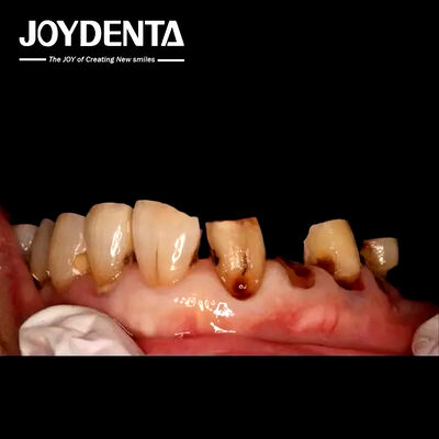 プレミアムジルコニアクラウン グローバル歯科ラボ
